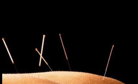 Close-up of acupuncture needles placed in skin