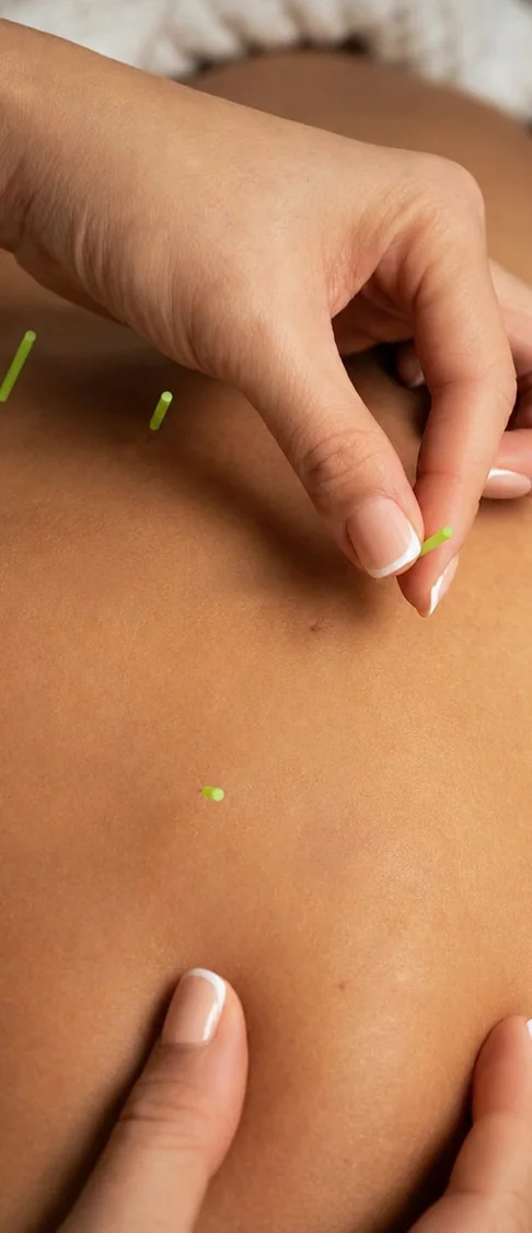 Acupuncture needle placement on a patient's back
