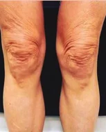 Before Scarlet PRO treatment