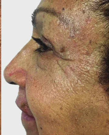 After NOUVADerm treatment