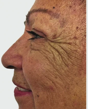 Before NOUVADerm treatment