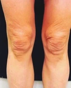 After Scarlet Pro treatment