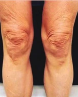 Before Scarlet Pro treatment